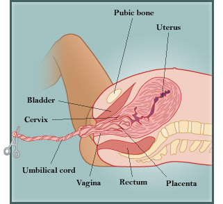 Birth diagram 3