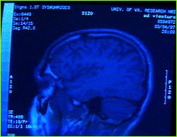 Screen shot of MRI scan of Viesturs' brain