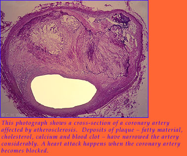 This photograph shows a cross-section of a coronary artery affected by atherosclerosis.  Deposits of plaque, which consists of fatty material, cholesterol, calcium and blood clot, have narrowed the artery considerably.  
A heart attack happens when the coronary artery becomes blocked.