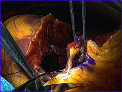 Batista procedure - cutting into the heart