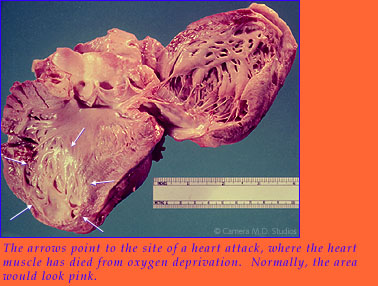 The arrows point to the site of a heart attack, where the heart muscle has died from oxygen deprivation.  Normally, the area would look pink.