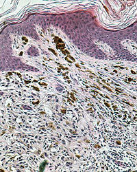 Microscopic view of early-stage skin cancer